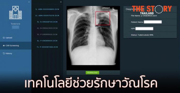ไอเน็ต จับมือ IBM ส่งเทคโนโลยีรักษาวัณโรค 75 โรงพยาบาลทั่วไทย