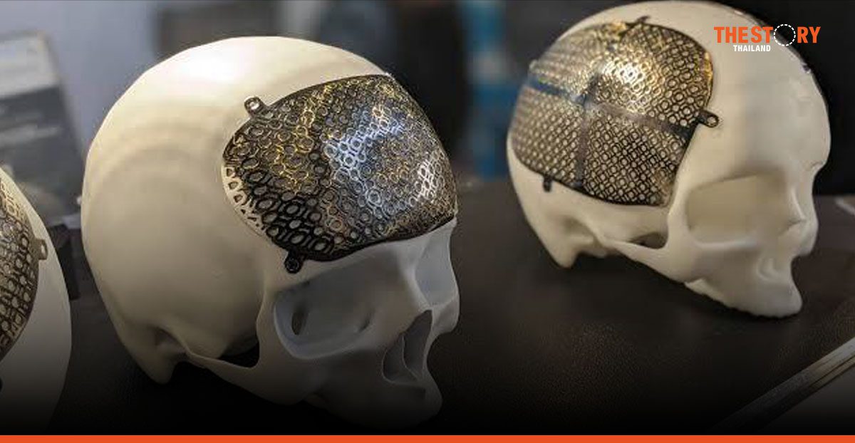 TCELS ติดตามผลการใช้ "แผ่นปิดกะโหลกไทเทเนียม" ในระบบหลักประกันสุขภาพ